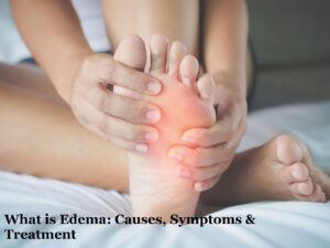 What is Edema: Causes, Symptoms & Treatment
